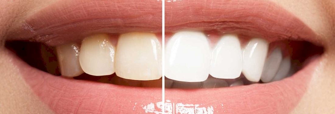 Домашнее отбеливание зубов при помощи кап и гелей до и после