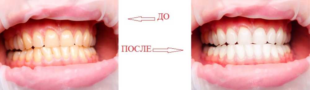 ZOOM-отбеливание зубов, фото