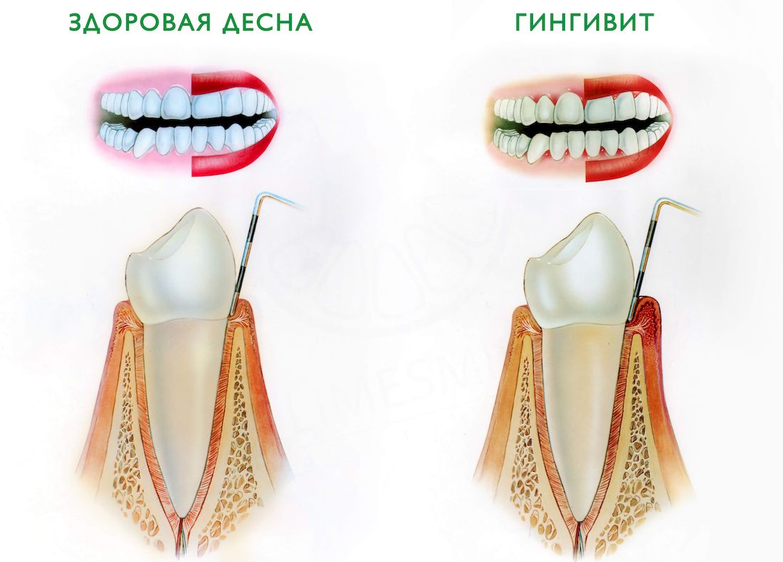 Признаки лечения зубов. Меркуриальный гингивит. Гипертрофированный гингивит.