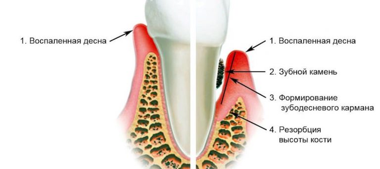 Пародонтит симптомы фото